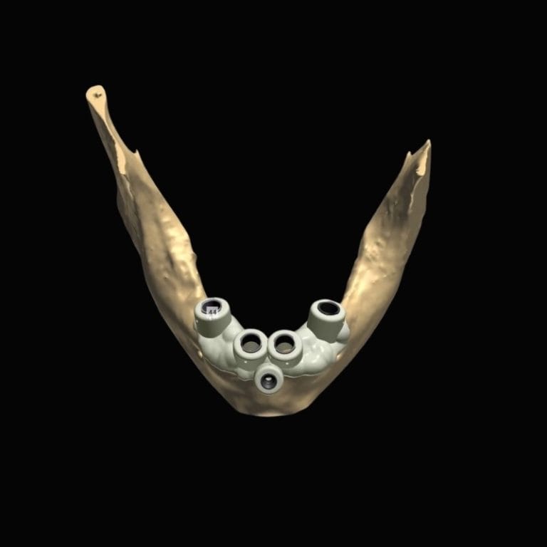 Surgical Guides – Krausz Dental Lab, Implantologie