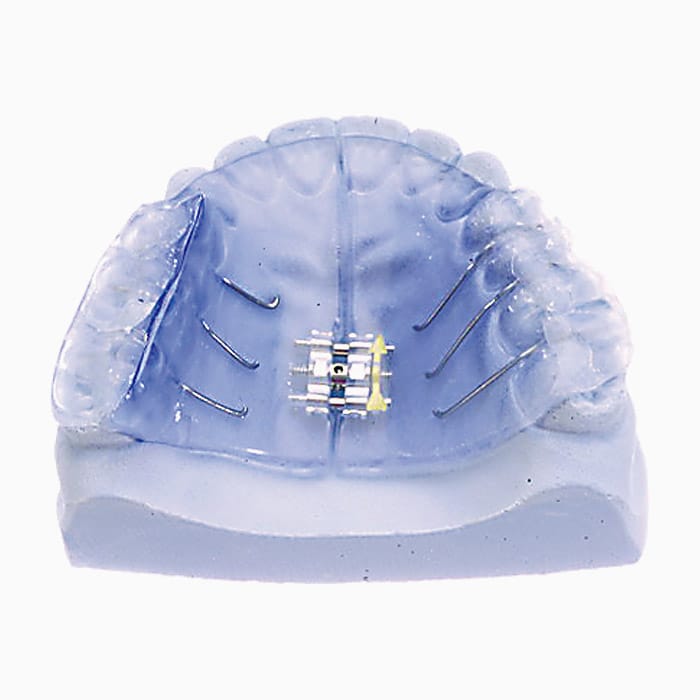Nord Unilateral Crossbite Expander EX/04 – lab3d, Sonstige Schienen