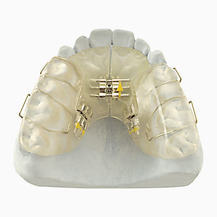 Three Way Sagittal Expander EX/11 – lab3d, Klasse-II-Apparaturen