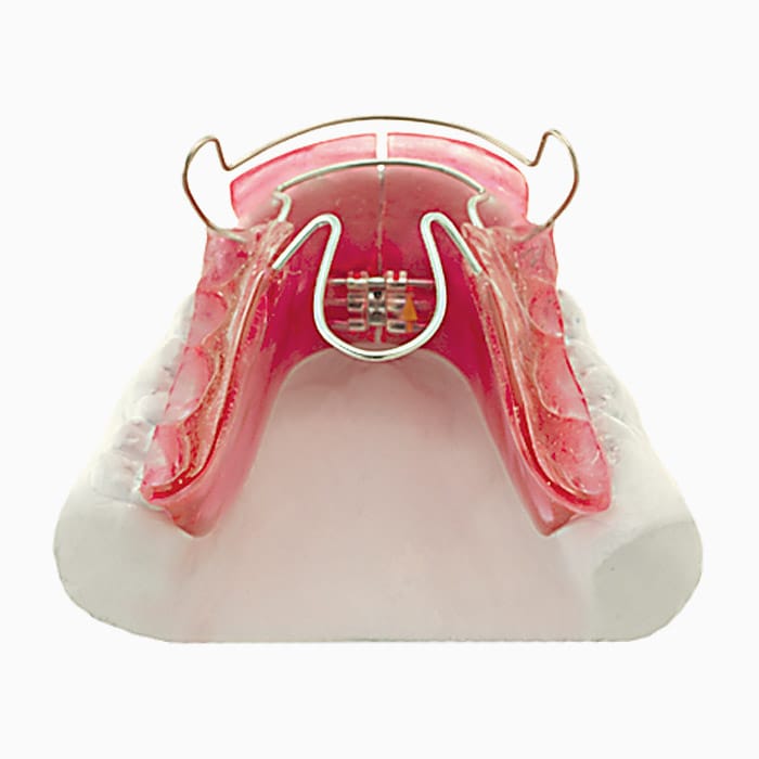 Standard Bionator III (To Open Bite) FA/03 – lab3d, Klasse-II-Apparaturen