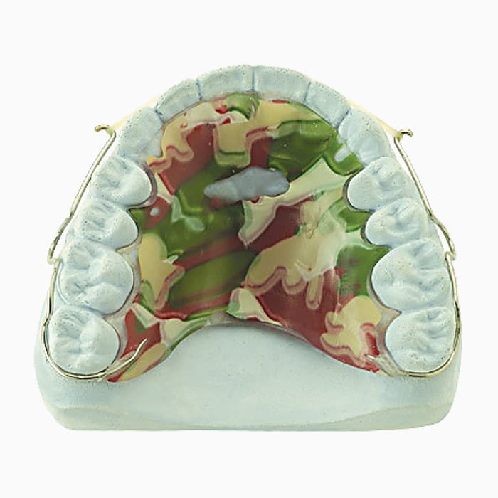 Minor Diastema Closing Retainer MD/15 – lab3d, Sonstige Schienen