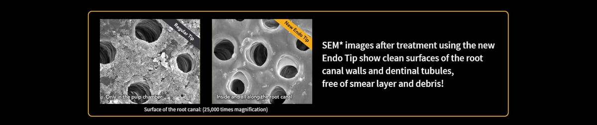 New Endo Tip for LiteTouch™ – Light Instruments Ltd, Zubehör für Wurzelbehandlung