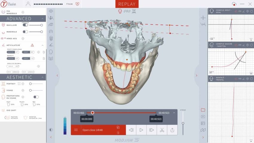 Modjaw™ - Twim Advanced – MODJAW, CAD/CAM-Software