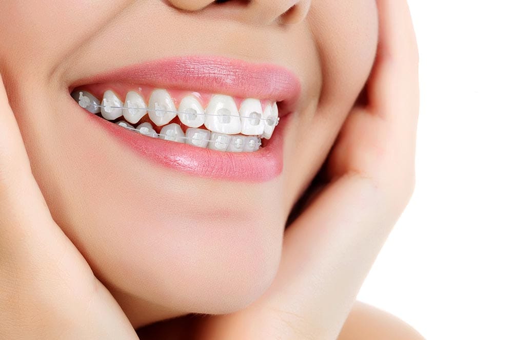 GENIUS CRYSTAL ADVANCED – Ortho Partner, Brackets