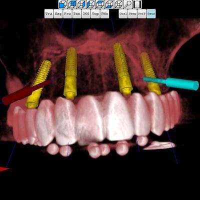 Organical Dental Implant – Organical CAD/CAM, CAD/CAM-Software
