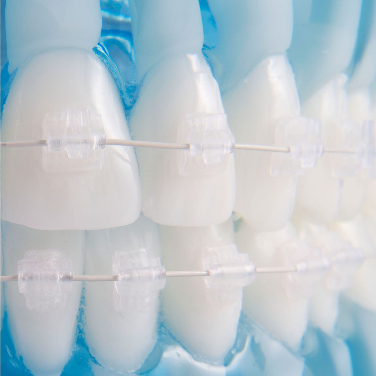Kosmetische NiTi Bögen – Orthobasics GmbH & Co. KG, Drähte und Bögen