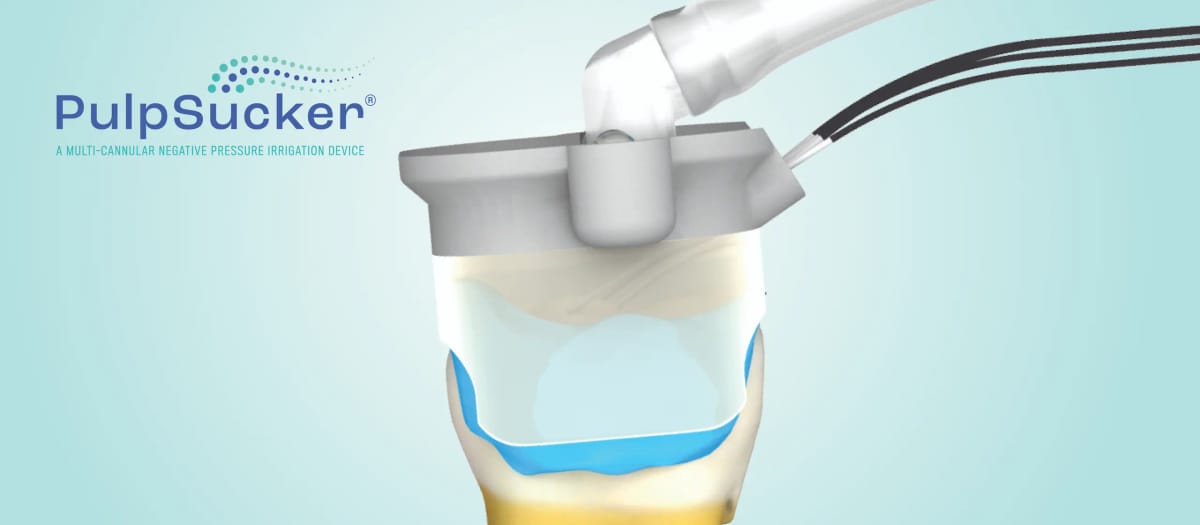 PulpSucker (PS) – PlanB Dental, Geräte