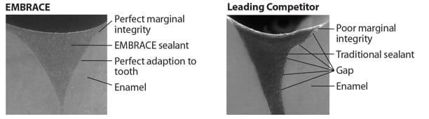 Embrace™ WetBond™ Pit & Fissure Sealant – Pulpdent Corporation, Fissurenversiegler