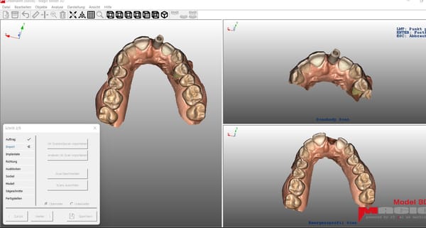 Magic Model 3D Implant - Implantatmodul fuer Dental CAD-Modelbuilder inkl. Zubehoer