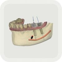 TRIOS implant planner app 420-200-01 – DENTAURUM, Software
