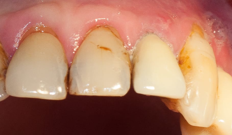Tree•Oss SIMPLE Implante cónico con hexágono interno de técnica simplificada – Tree-Oss S.R.L., Implantate