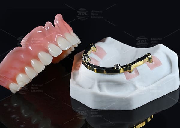 China Dental Lab Titanium Locator Attachment with full acrylic over denture