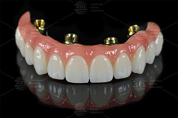 All On X Implant Retained Bar with Screw Retained Zirconia Bridge Engineered To Deliver Superior Retention And Stability Chinese Dental Lab