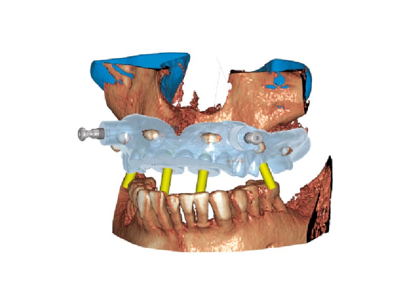 exoplan - Modulo Guide Creator – Castellini, CAD/CAM-Software