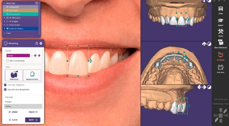 Smile Creator-Modul mit TruSmile – Castellini, CAD/CAM-Software