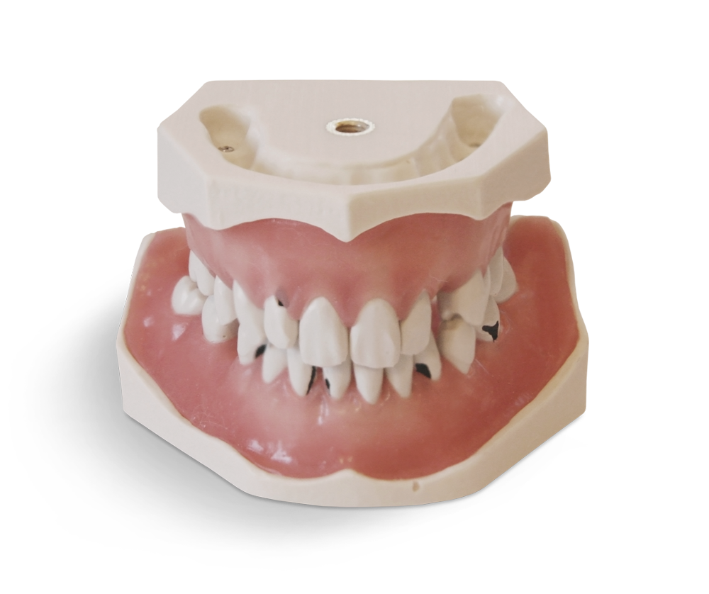 E06 – Parodontologisches Modell mit schraubbefestigten Zähnen – GF Dental di Ficuciello Antonino, Demomodelle