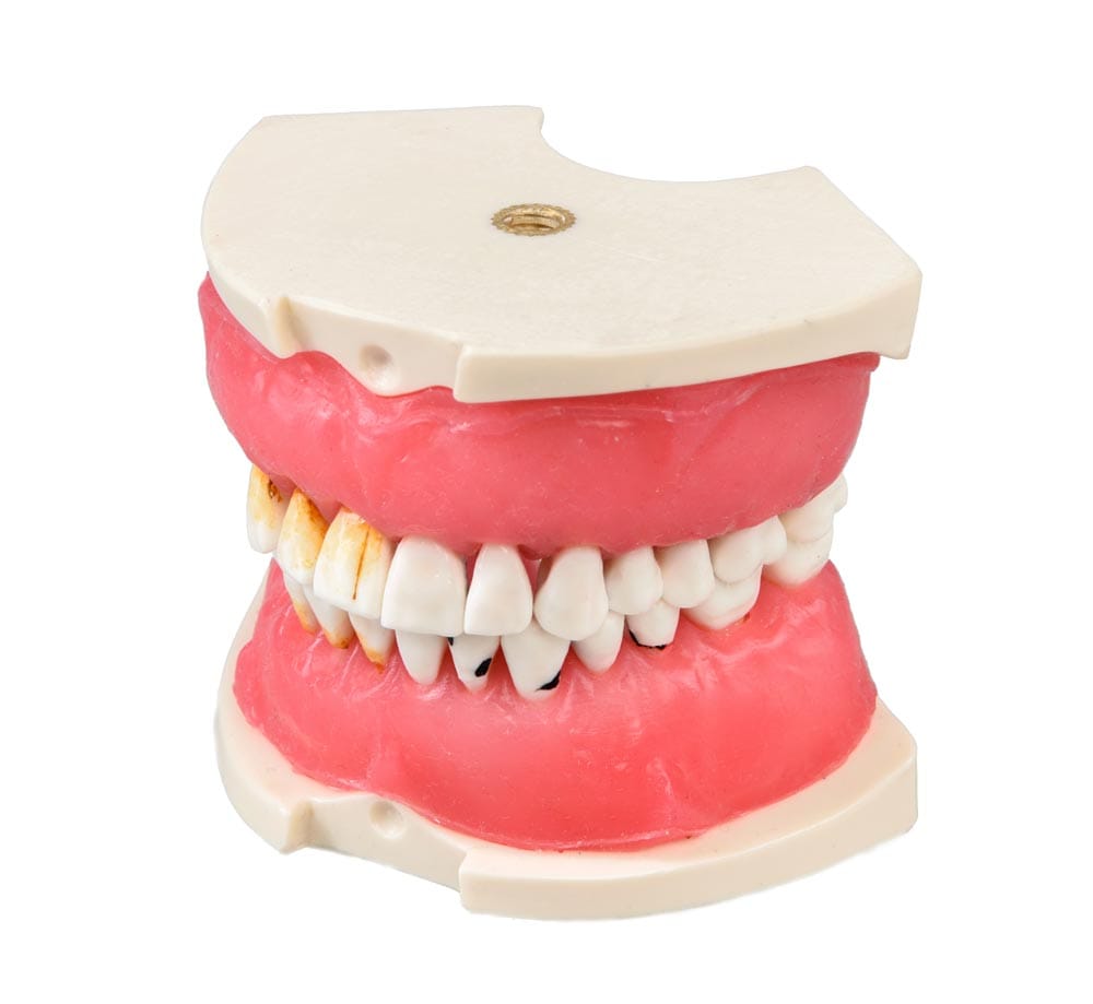 E26 – Modell mit parodontopathischem Zahnfleisch – GF Dental di Ficuciello Antonino, Demomodelle