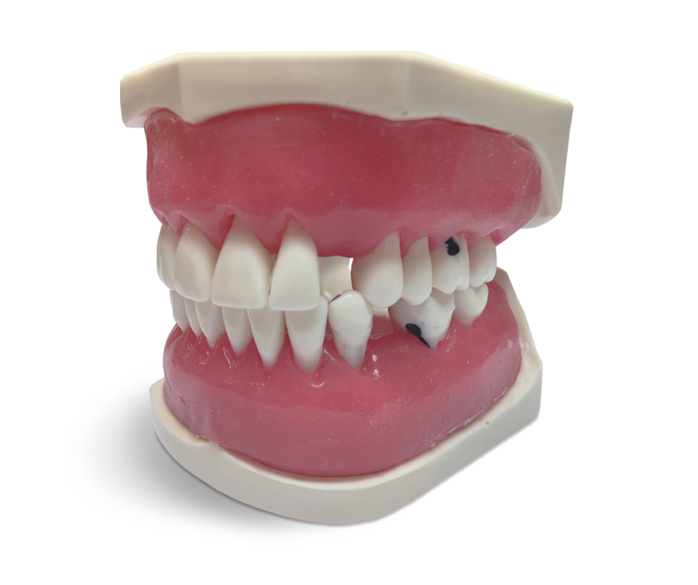 E56 – Parodontologisches Modell mit schraubbefestigten Zähnen – GF Dental di Ficuciello Antonino, Demomodelle