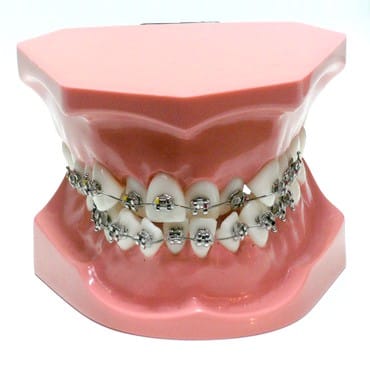 ORB02 – Kieferorthopädisches Modell mit frontaler Engstand – GF Dental di Ficuciello Antonino, Demomodelle