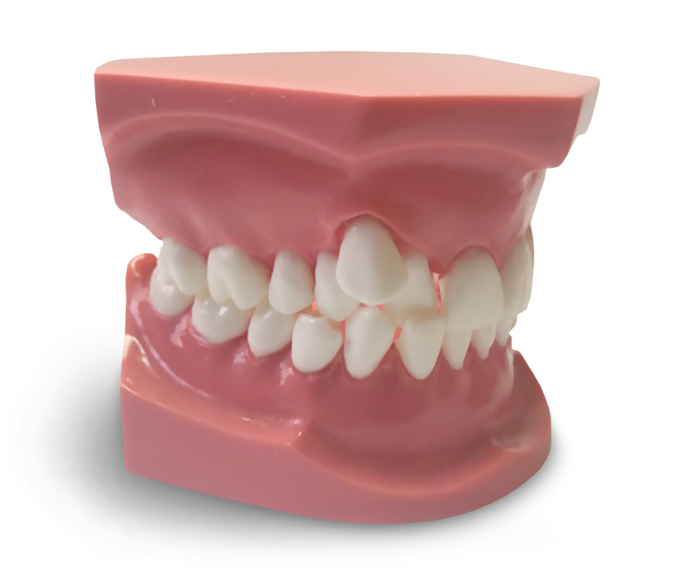 ORB05 – Kieferorthopädisches Modell mit ektopem Eckzahndurchbruch – GF Dental di Ficuciello Antonino, Demomodelle