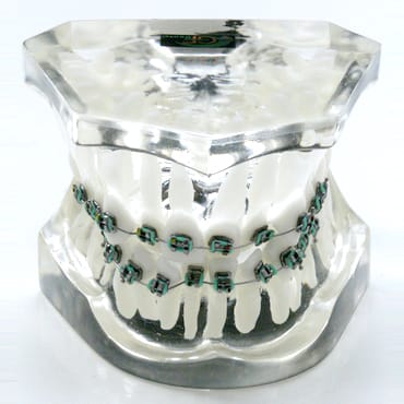 1 class model with front crowding – GF Dental di Ficuciello Antonino, Gipszusätze, Stumpflacke und Gipslöser