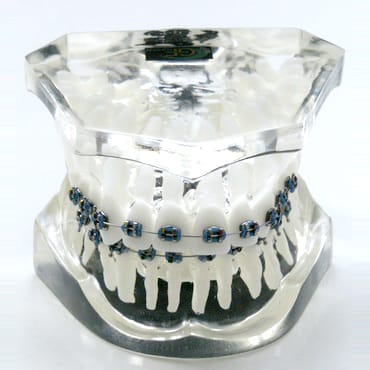 Orthodontic model 1 class 2 division – GF Dental di Ficuciello Antonino, Gipszusätze, Stumpflacke und Gipslöser