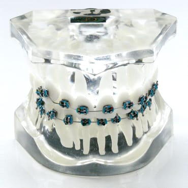 Orthodontic model with ectopic eruption of the canine – GF Dental di Ficuciello Antonino, Gipszusätze, Stumpflacke und Gipslöser