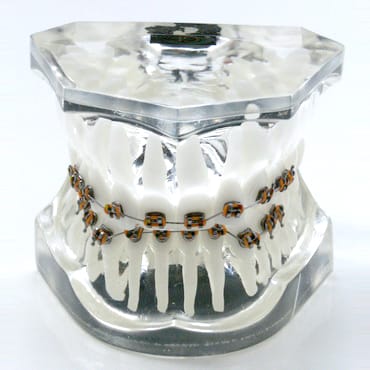 Transparent orthodontic model 2 class 2 division – GF Dental di Ficuciello Antonino, Gipszusätze, Stumpflacke und Gipslöser