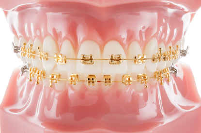 Royal Typodont – Einzelstück – IOS International Orthodontic Services, Intraorale Geräte