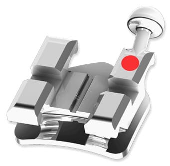 Bio-progressive kieferorthopädische Metallbrackets – Modern Orthodontics, Brackets