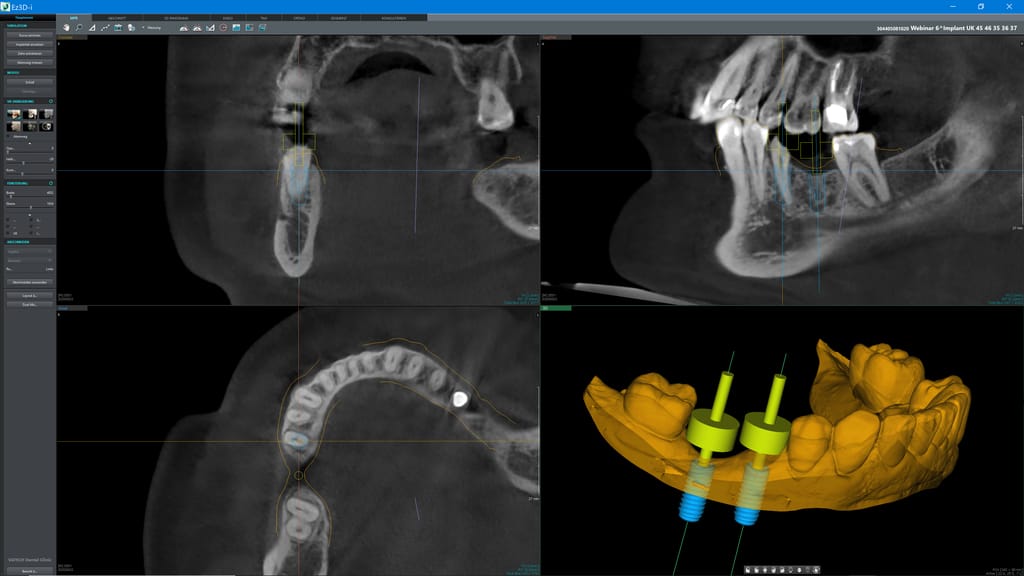 byzz® Ez3D-i – orangedental, CAD/CAM-Software