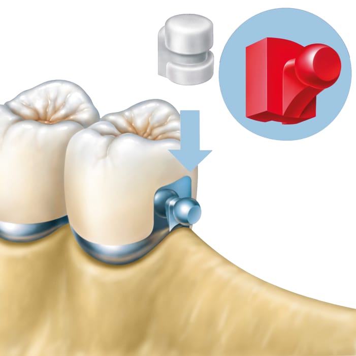 Kugelanker vertikal – Servo-Dental, Geschiebe