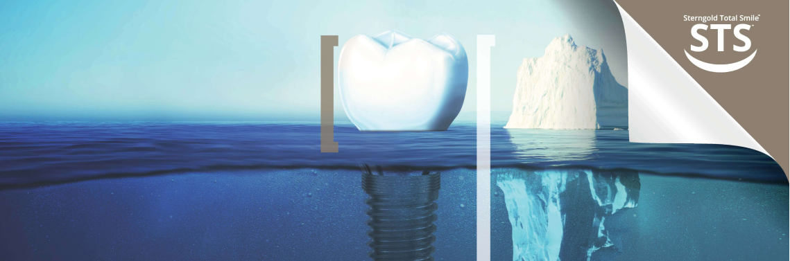 STS5: Festsitzende Hybridprothese – Sterngold Dental, LLC, Implantate