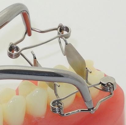 New tooth matrices for one-sided deep caries – Dr. Walser Dental, Walser Matrizen